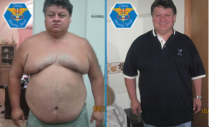 Clinica para Adelgazar para Hombres